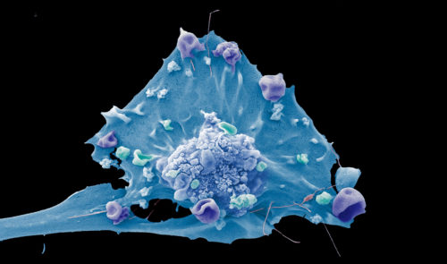 Breast cancer cell